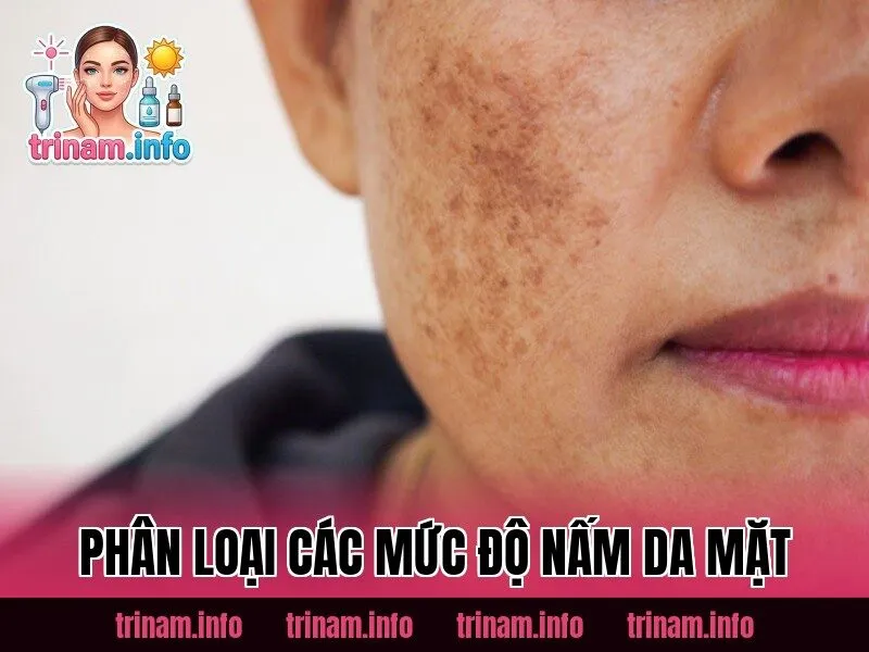 Phân loại các mức độ nấm da mặt