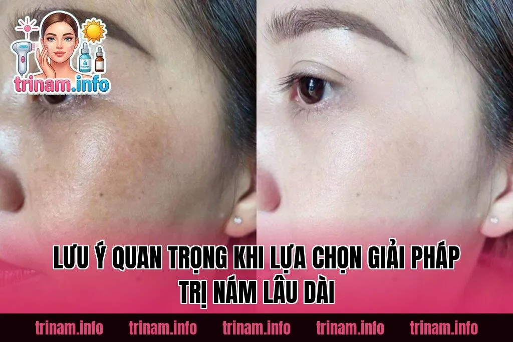 Lưu ý quan trọng khi lựa chọn giải pháp trị nám lâu dài
