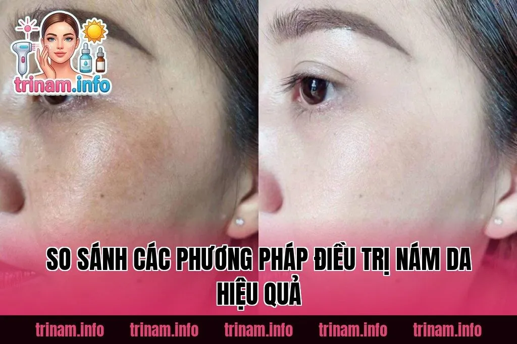 So sánh các phương pháp điều trị nám da hiệu quả