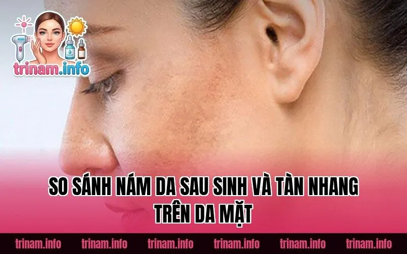 So sánh nám da sau sinh và tàn nhang trên da mặt