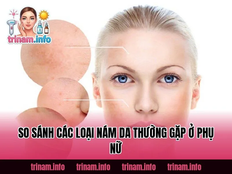 So sánh các loại nám da thường gặp ở phụ nữ
