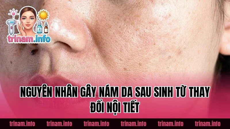 Nguyên nhân gây nám da sau sinh từ thay đổi nội tiết