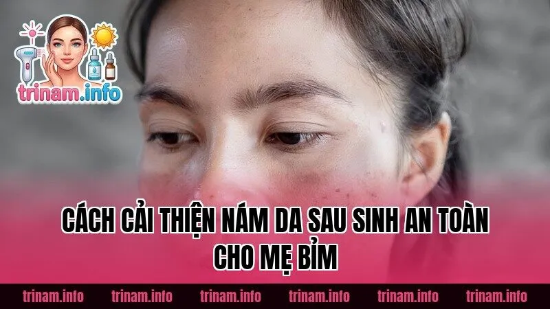 Cách cải thiện nám da sau sinh an toàn cho mẹ bỉm