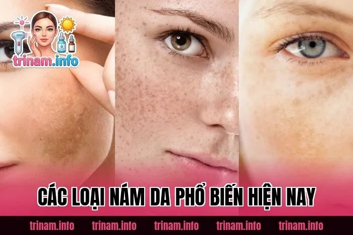 Các Loại Nám Da Phổ Biến Hiện Nay