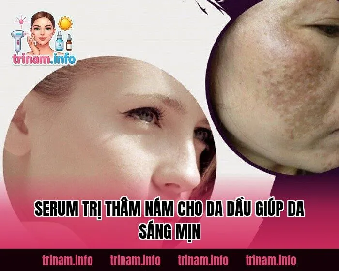 Serum Trị Thâm Nám Cho Da Dầu Giúp Da Sáng Mịn