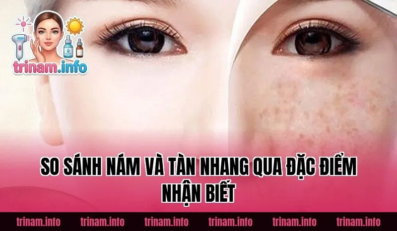 So sánh nám và tàn nhang qua đặc điểm nhận biết