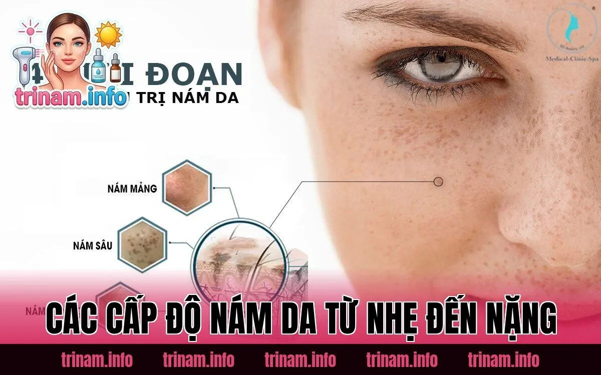 Các cấp độ nám da từ nhẹ đến nặng