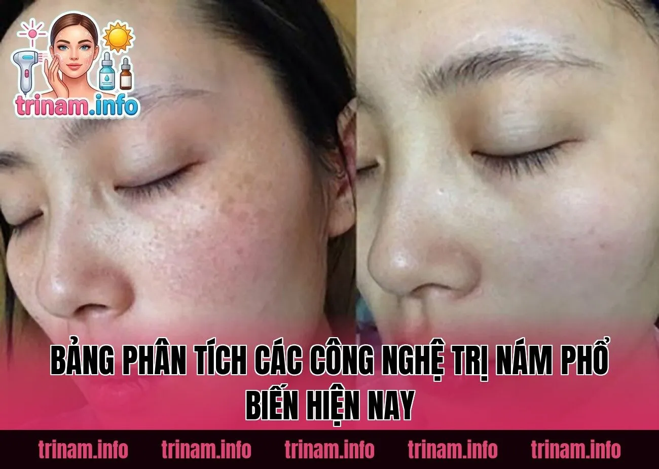 Bảng phân tích các công nghệ trị nám phổ biến hiện nay