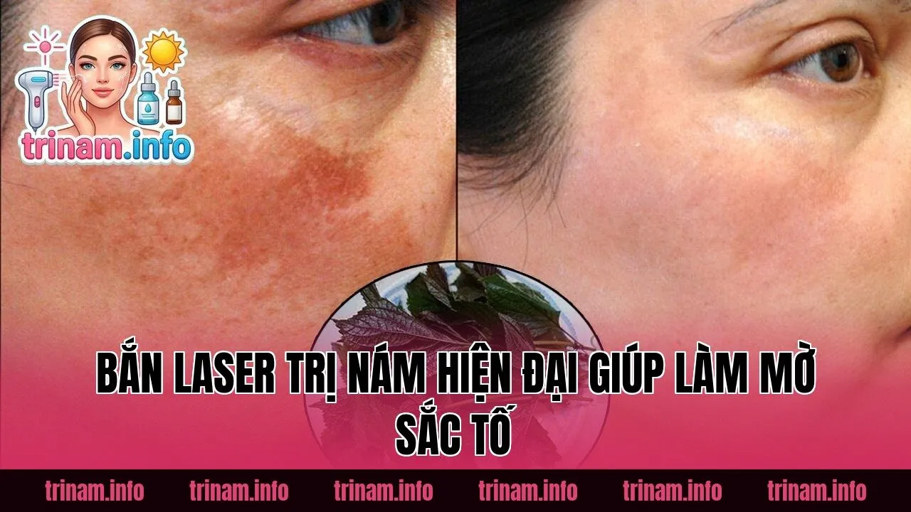 Bắn Laser Trị Nám Hiện Đại Giúp Làm Mờ Sắc Tố