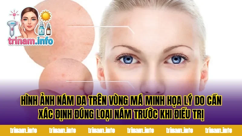 Hình ảnh nám da trên vùng má minh họa lý do cần xác định đúng loại nám trước khi điều trị