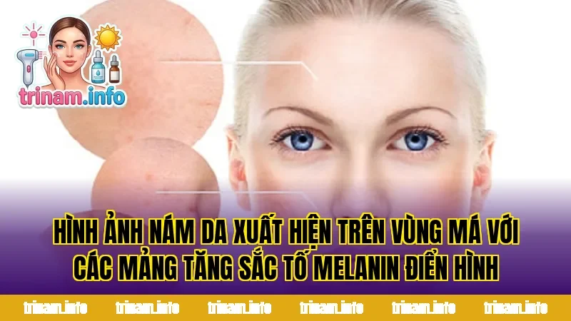 Hình ảnh nám da xuất hiện trên vùng má với các mảng tăng sắc tố melanin điển hình