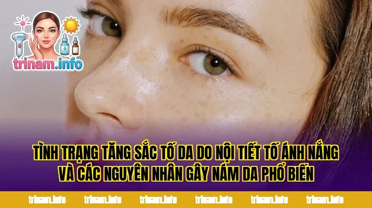 Tình trạng tăng sắc tố da do nội tiết tố ánh nắng và các nguyên nhân gây nám da phổ biến